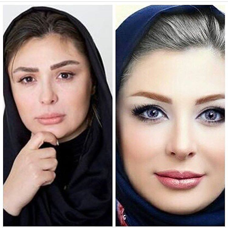 نیوشا ضیغمی یعد از عمل نیوشا ضیغمی یعد از عمل