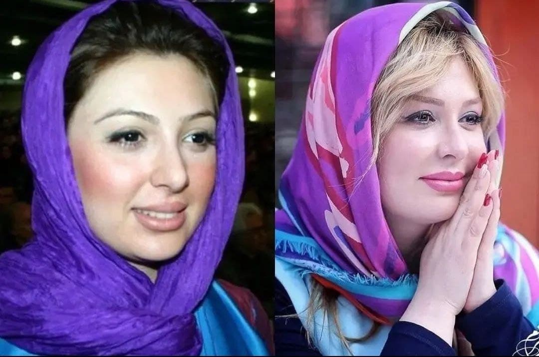 نیوشا ضیغمی قبل از عمل نیوشا ضیغمی قبل از عمل